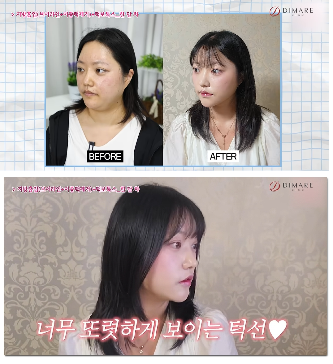 디마레 비포에프터4 - 눈밑꺼짐