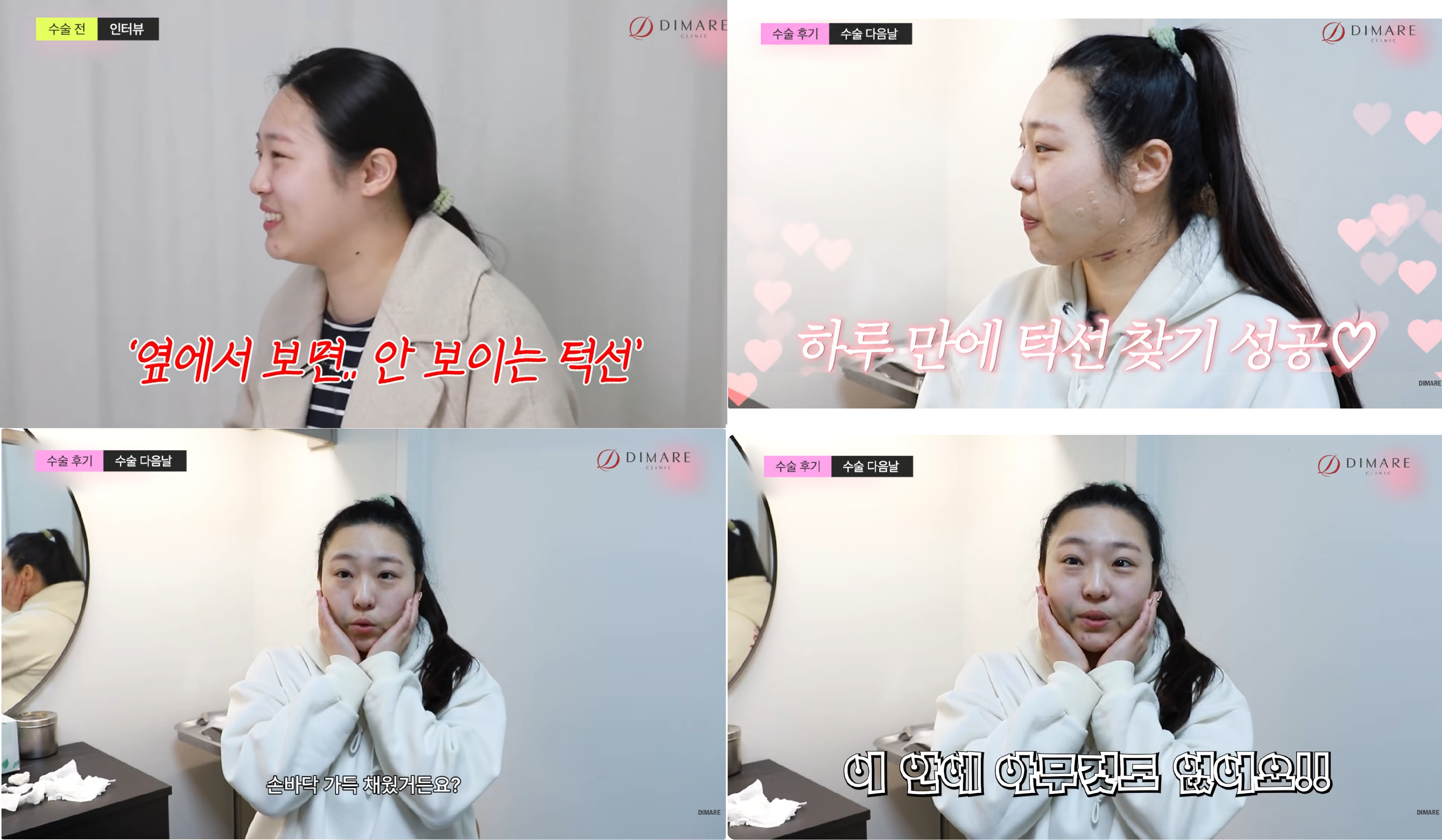 디마레 비포에프터5 - 심부볼제거