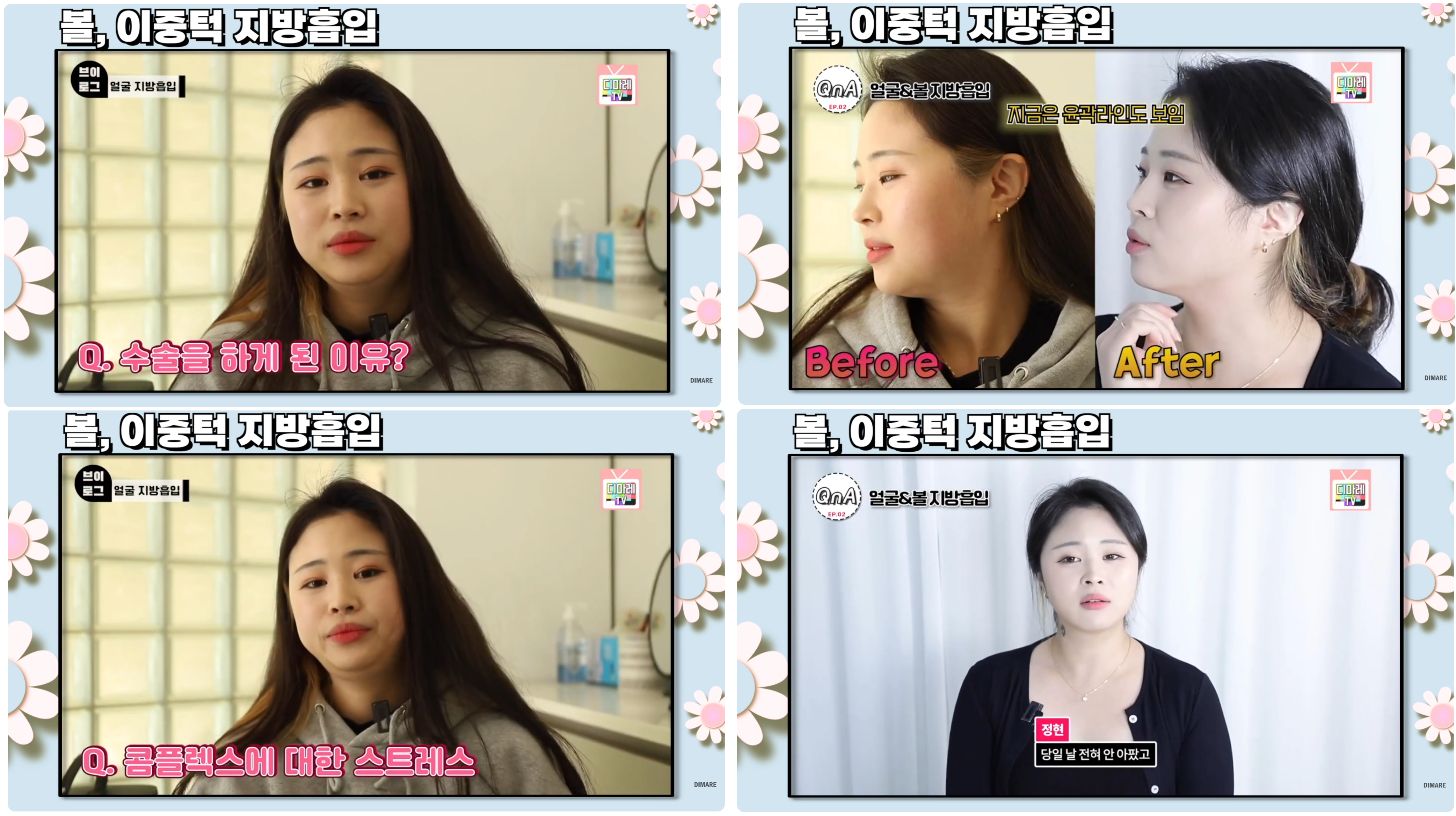 디마레 비포에프터3 - 이중턱