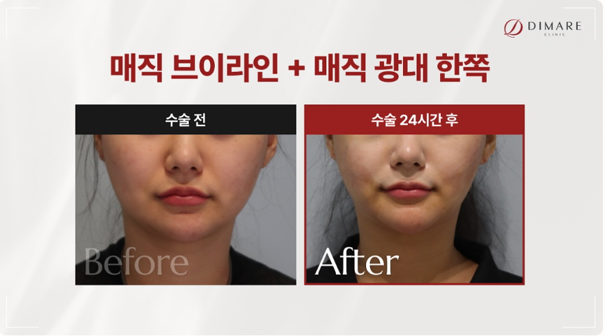 디마레 비포에프터1 - 얼굴살빼는법