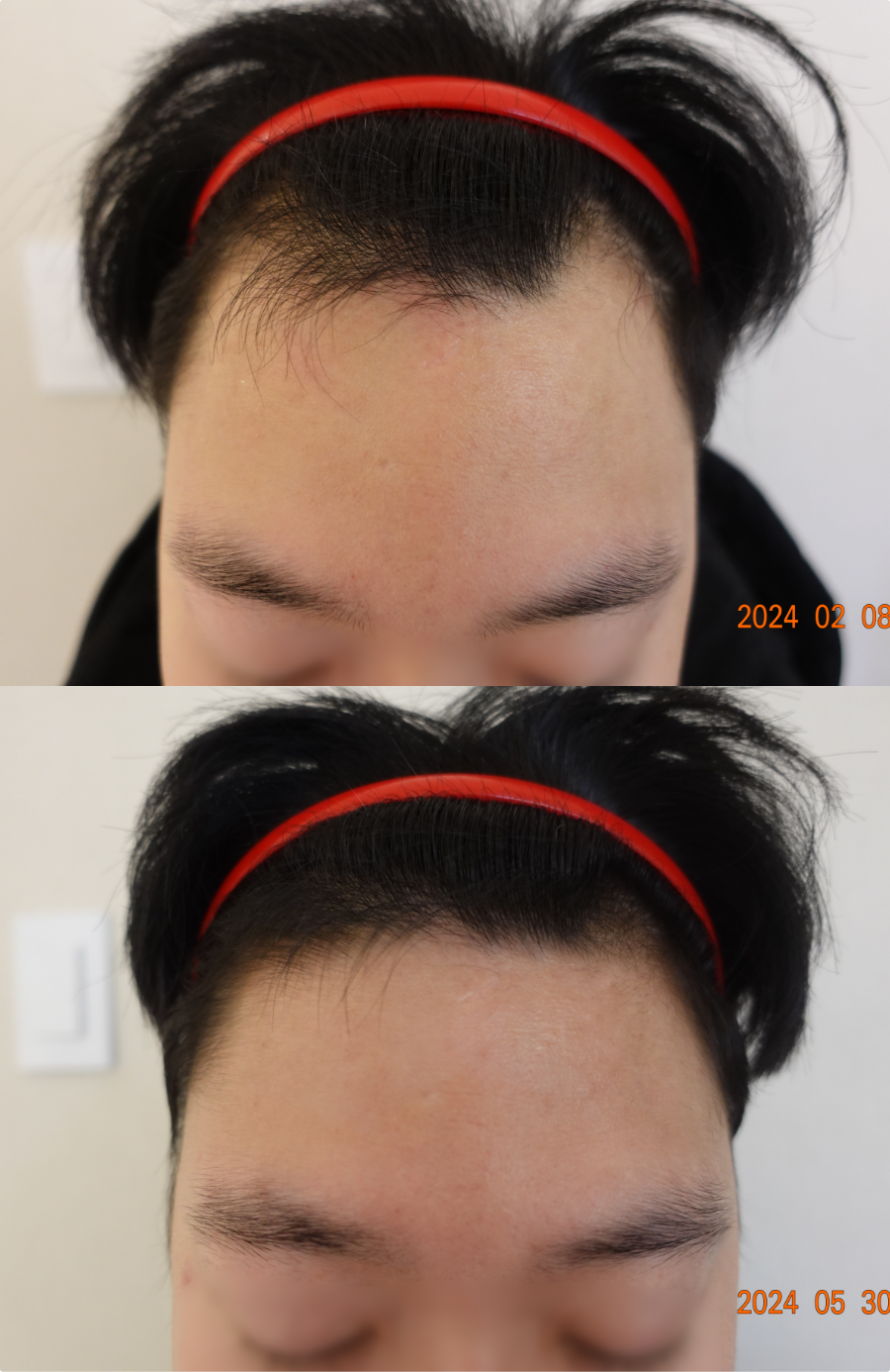https://hospitals-media.s3.ap-northeast-2.amazonaws.com/dermoclinic/media/boards/2025/12/BA_05_4k8HUm8.png