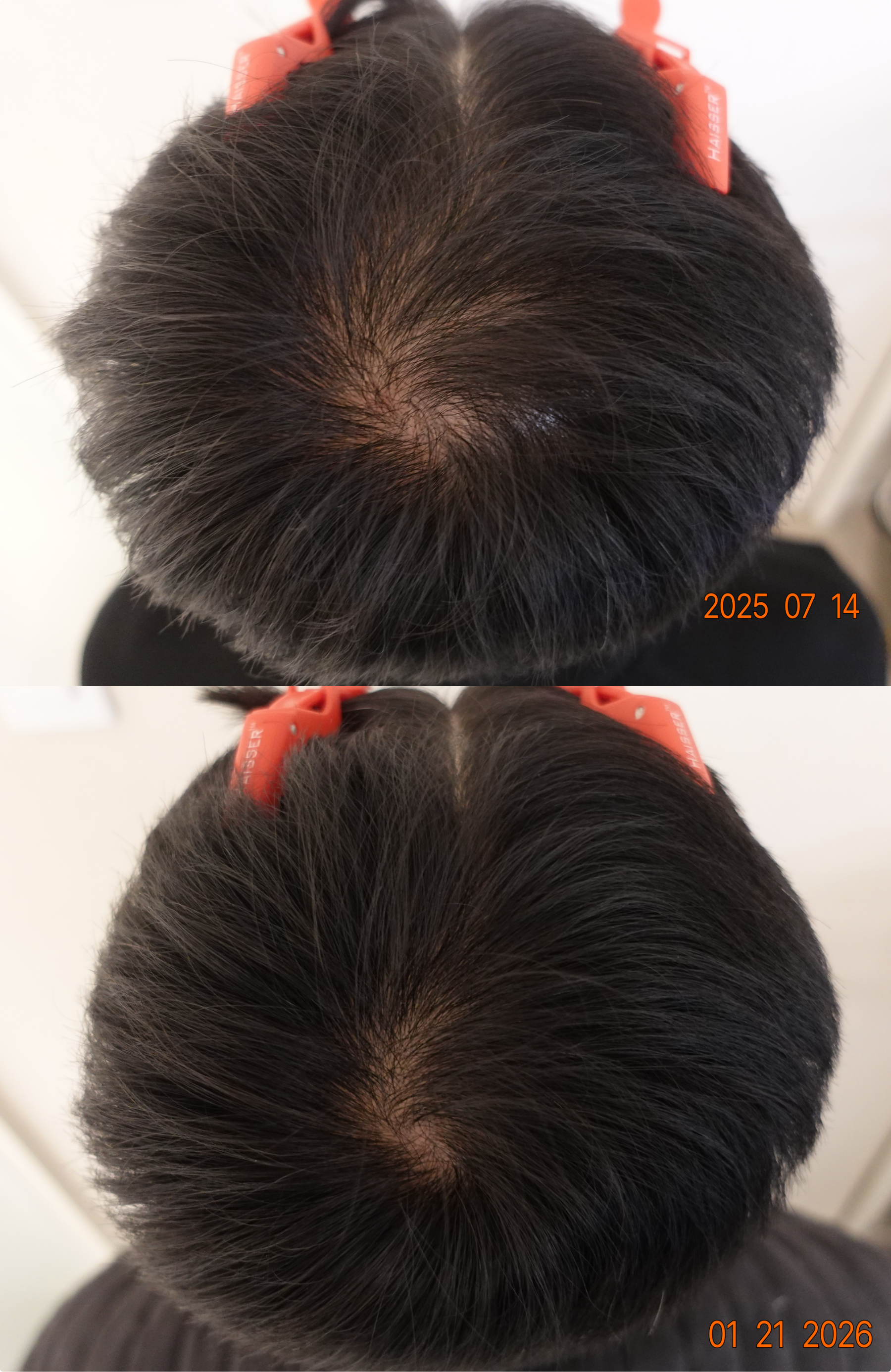 https://hospitals-media.s3.ap-northeast-2.amazonaws.com/dermoclinic/media/boards/2026/01/BA_01_3MxTm2I.png