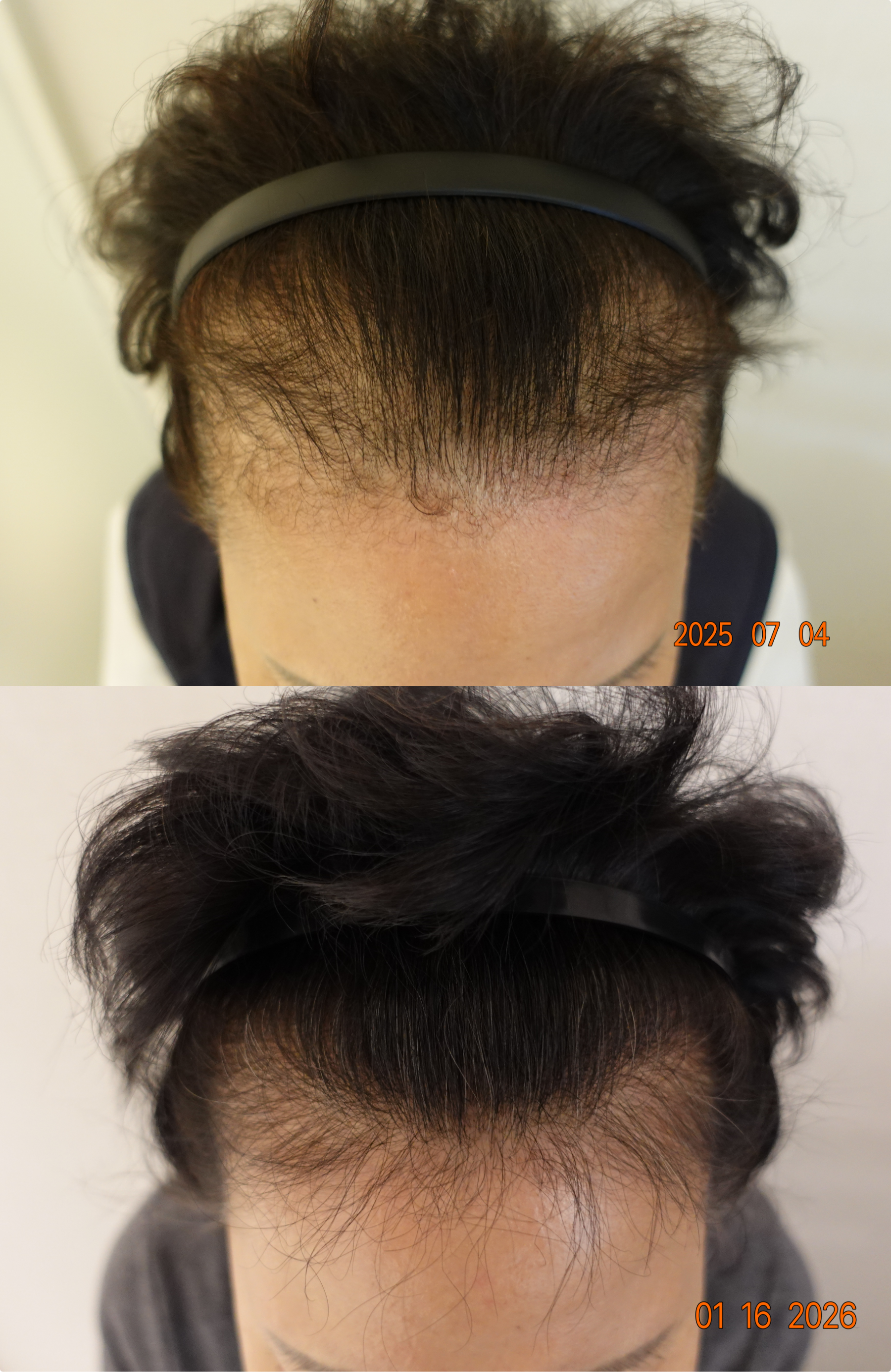 https://hospitals-media.s3.ap-northeast-2.amazonaws.com/dermoclinic/media/boards/2026/01/BA_02_yp1F9Go.png