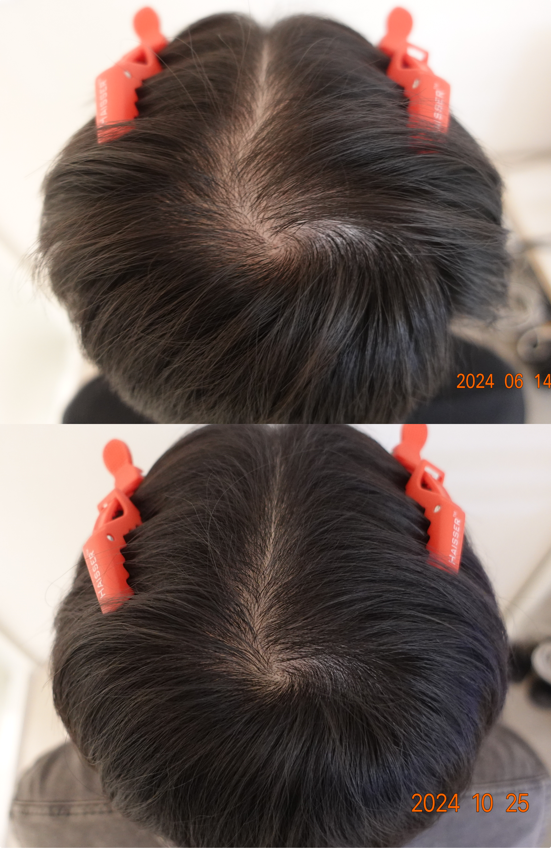 https://hospitals-media.s3.ap-northeast-2.amazonaws.com/dermoclinic/media/boards/2026/01/BA_03.png