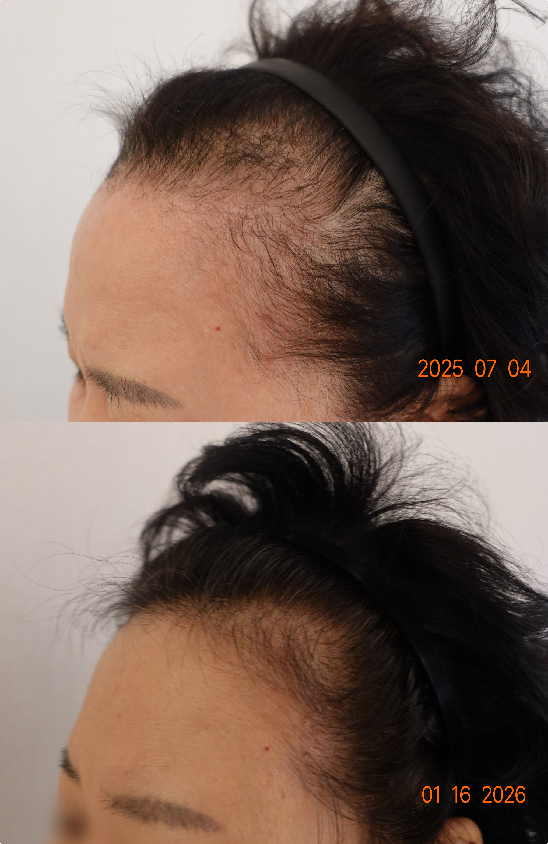 https://hospitals-media.s3.ap-northeast-2.amazonaws.com/dermoclinic/media/boards/2026/01/BA_03_49F6Yyk.png