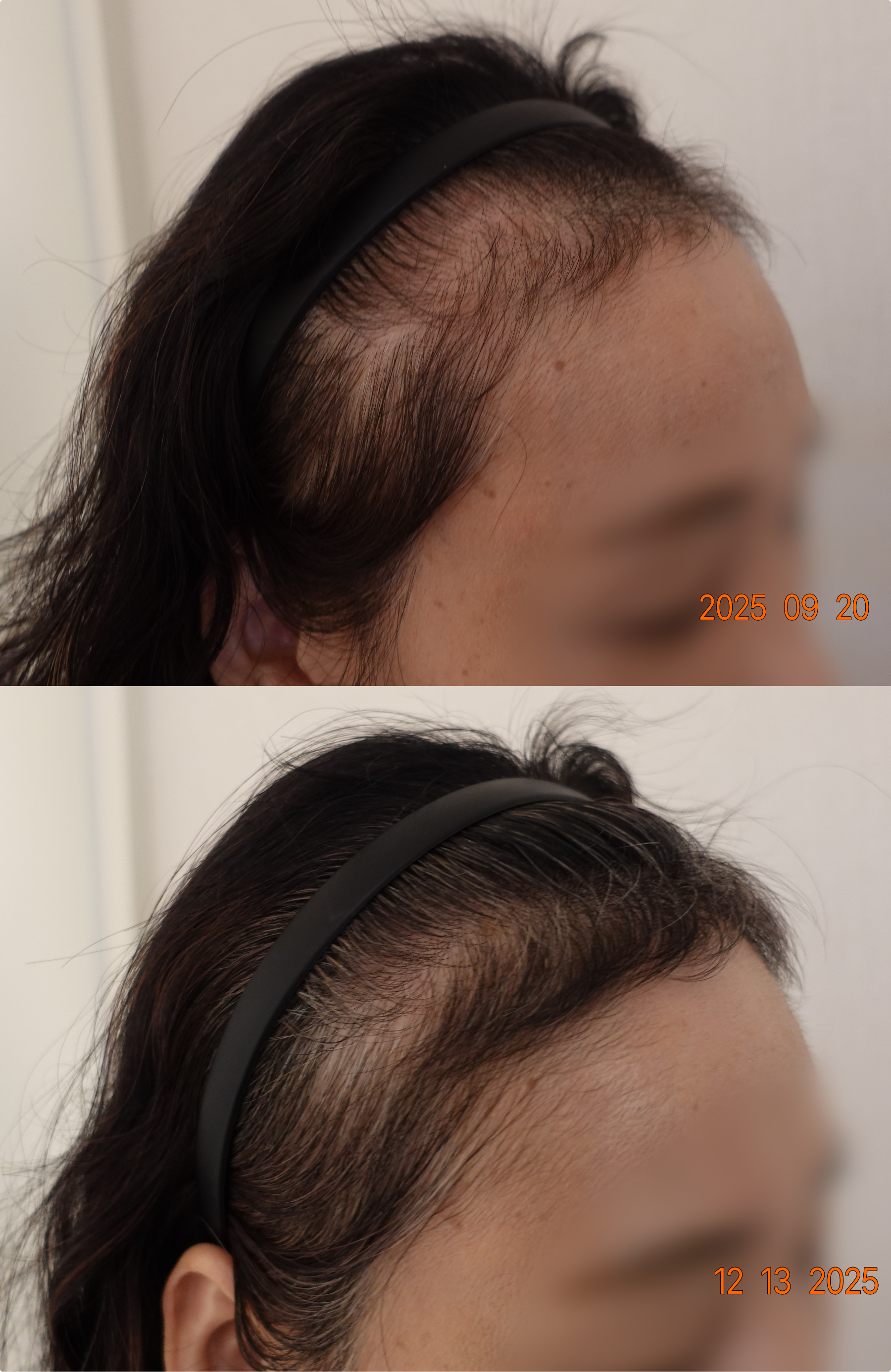 https://hospitals-media.s3.ap-northeast-2.amazonaws.com/dermoclinic/media/boards/2026/01/BA_17_EmUthzI.png