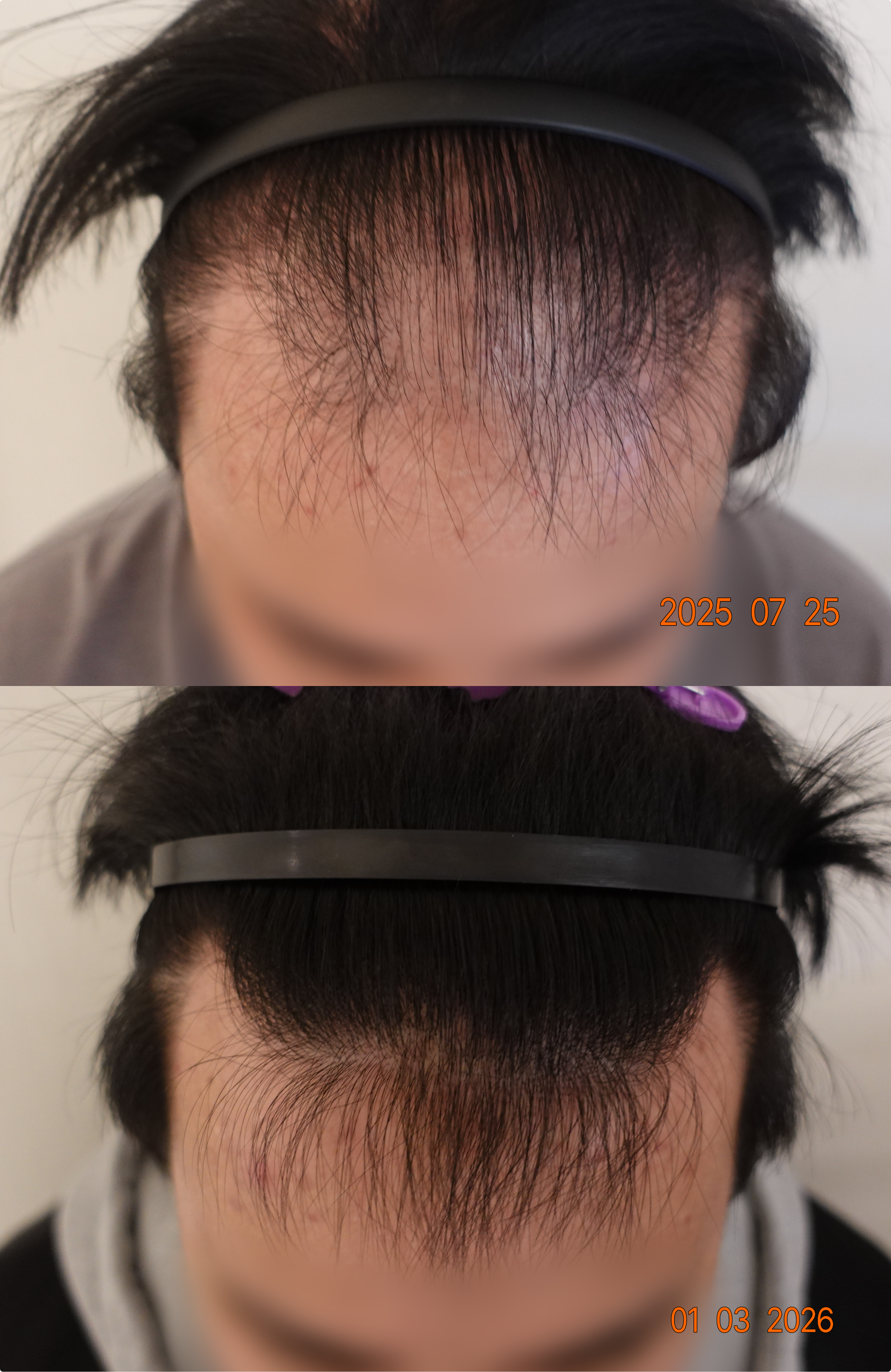 https://hospitals-media.s3.ap-northeast-2.amazonaws.com/dermoclinic/media/boards/2026/01/BA_18.png
