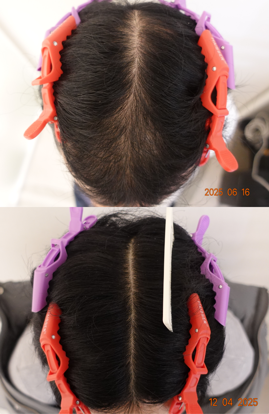 https://hospitals-media.s3.ap-northeast-2.amazonaws.com/dermoclinic/media/boards/2026/01/BA_23.png