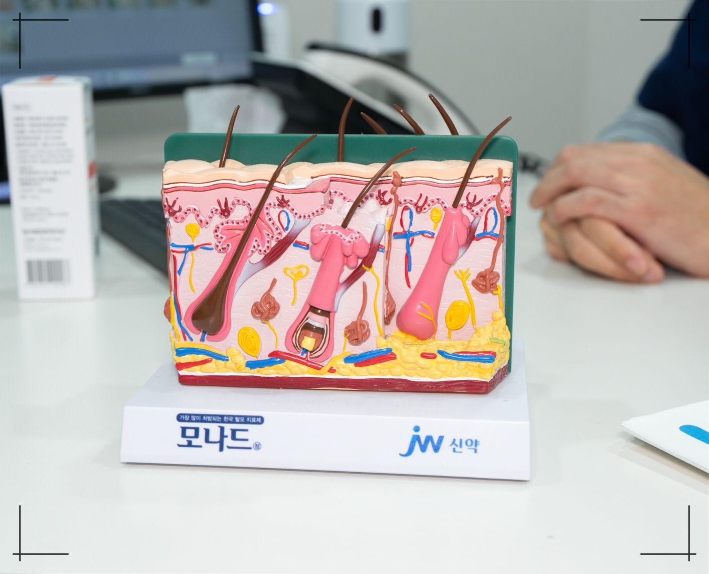 여자 탈모 자가진단 여성형 탈모 특징