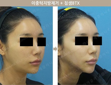 이중턱지방제거 + 침샘BTX
