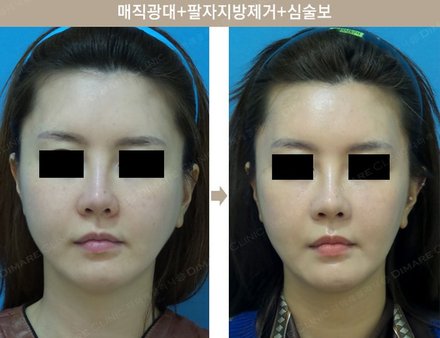 매직광대+팔자지방제거+심술보제거