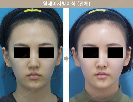 원데이지방이식 (전체)