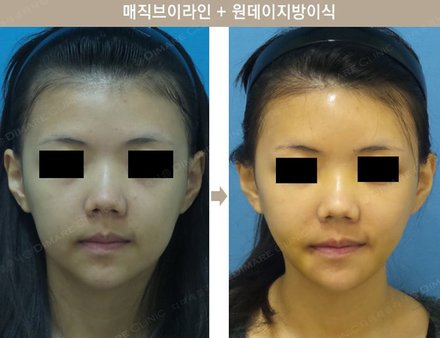 매직브이라인 + 원데이지방이식
