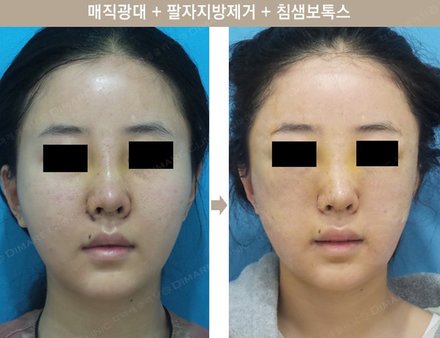 매직광대 + 팔자지방제거 + 침샘보톡스
