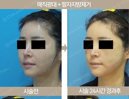 매직 광대 + 팔자지방제거