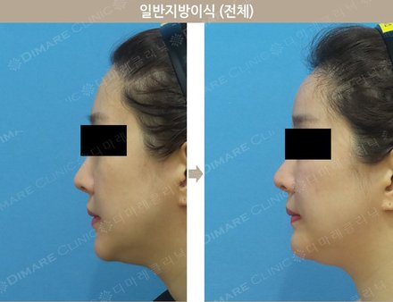 일반지방이식(전체)