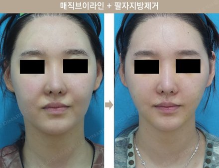 매직브이라인 + 팔자지방제거