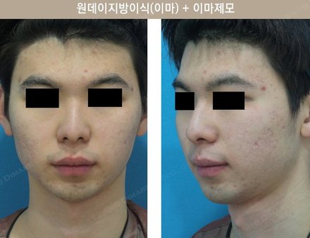 원데이지방이식(이마) + 이마제모