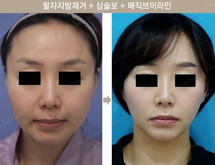 팔자지방제거 + 심술보 + 매직브이라인