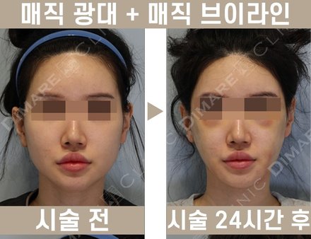 매직광대 + 매직브이라인 지방흡입