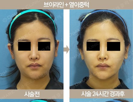 브이라인 + 옆이중턱