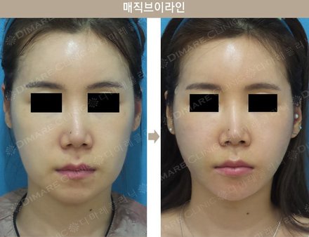 매직브이라인