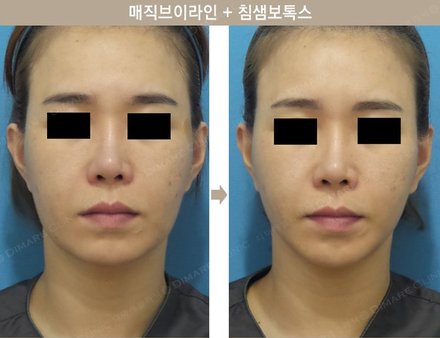 매직브이라인 + 침샘보톡스