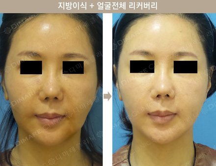 지방이식 + 얼굴전체 리커버리