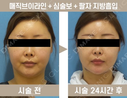 매직브이라인 + 심술보 + 팔자 지방흡입