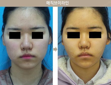 매직브이라인