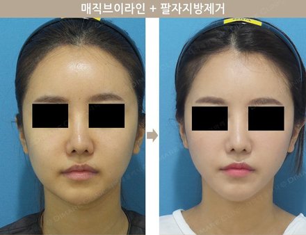 매직브이라인 + 팔자지방제거