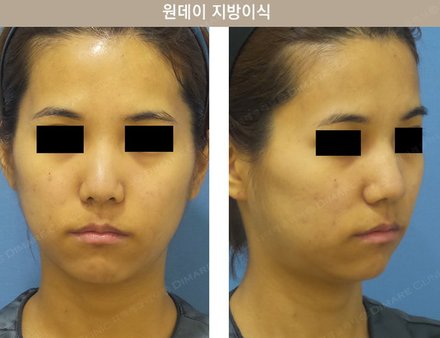 원데이지방이식