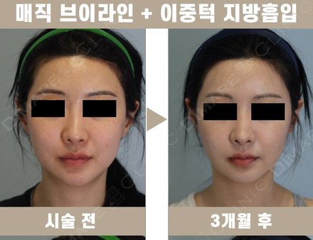 매직브이라인 + 이중턱 지방흡입