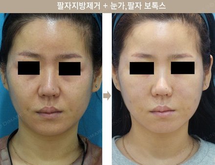 팔자지방제거 + 눈가, 팔자 보톡스
