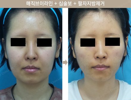 매직브이라인 + 심술보 + 팔자지방제거