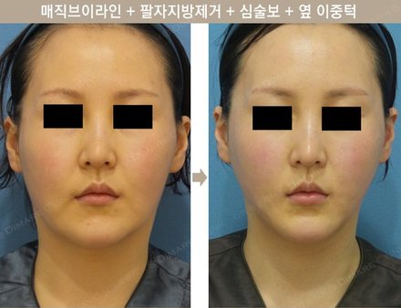 매직브이라인 + 팔자지방제거 + 심술보 + 옆 이중턱