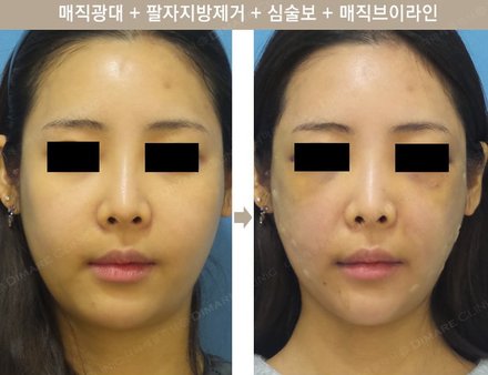 매직광대 + 팔자지방제거 + 심술보 + 매직브이라인