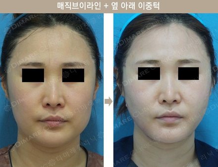 매직브이라인 +  옆 아래 이중턱