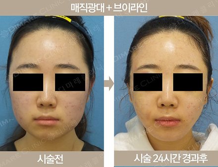 매직광대 + 브이라인