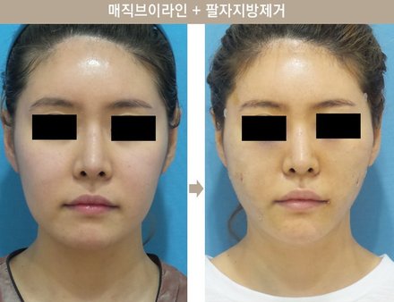 매직브이라인 + 팔자지방제거