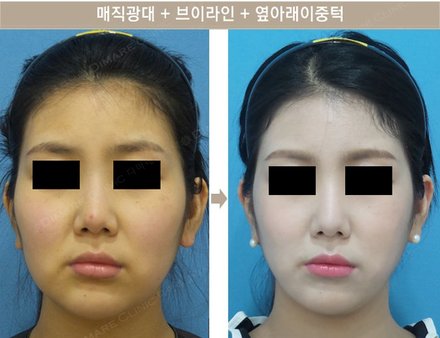 매직광대 + 브이라인 + 옆아래이중턱