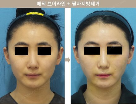 매직브이라인 + 팔자지방제거