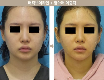 매직브이라인 + 옆아래이중턱