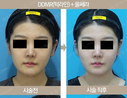 DDMR(턱라인) + 울쎄라