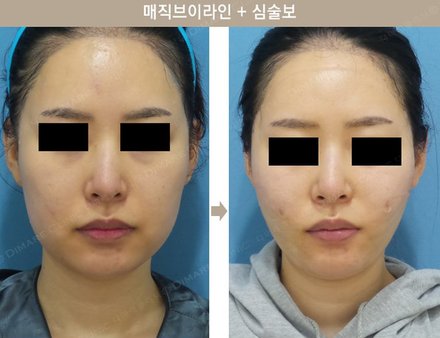 매직브이라인 + 심술보