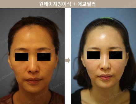 원데이지방이식+애교필러