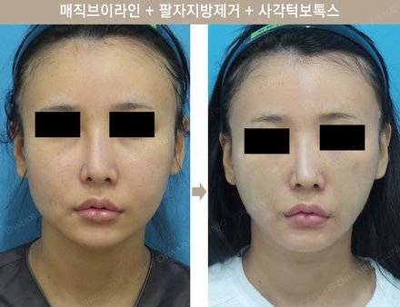 매직브이라인 + 팔자지방제거 + 사각턱보톡스