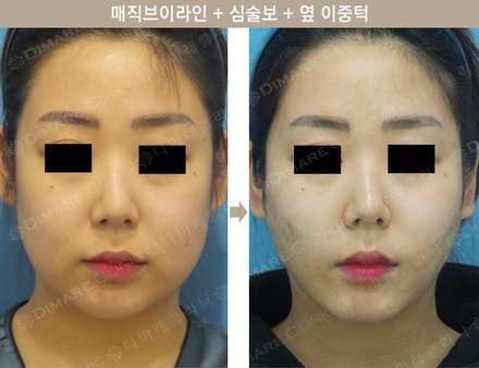 매직브이라인 + 심술보 + 옆 이중턱