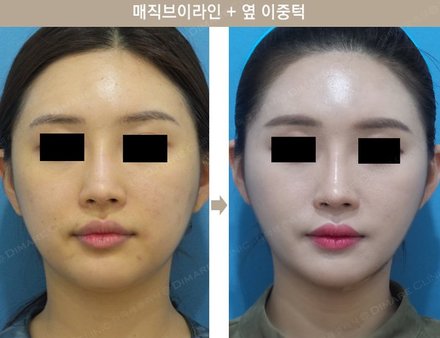 매직브이라인 + 옆 이중턱