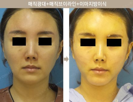 매직광대 + 매직브이라인 + 이마지방이식